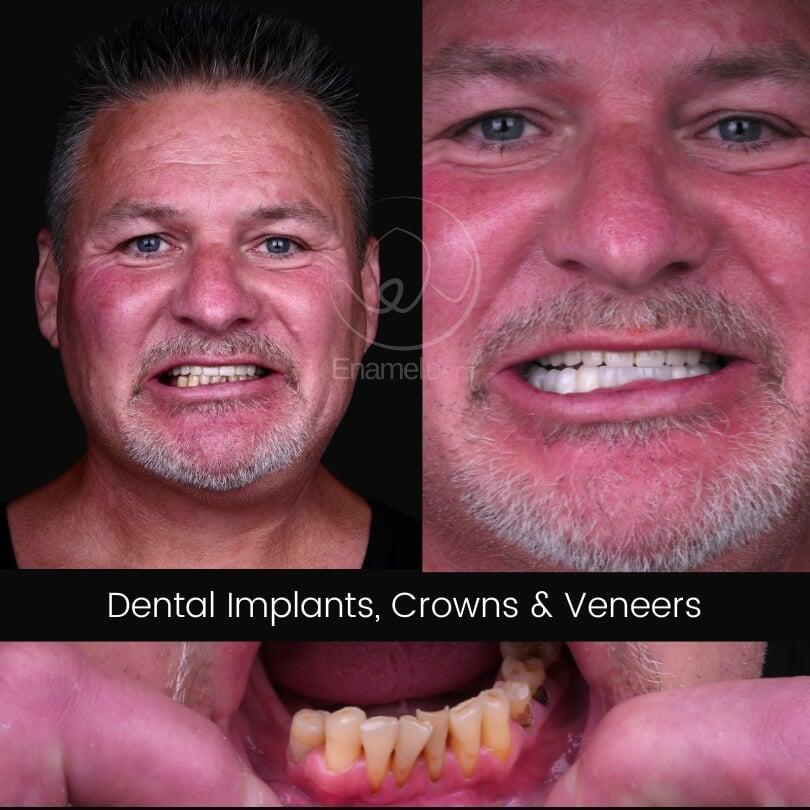 Dental implants, crowns and veneers restore missing teeth, improve strength and create a natural smile.